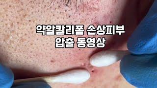 약알칼리폼 손상피부 압출 동영상