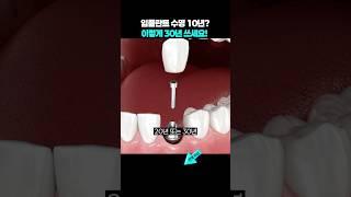 임플란트 수명 10년? '이렇게' 평생 쓰세요.