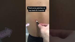 Back Acne? Try an Acne Patch!  #skincare #acne #acnetreatment #pimples