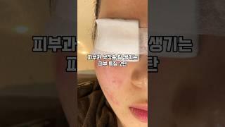 피부과 부작용 잘 생기는 피부 2탄