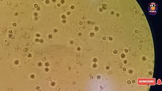 Pus cells in urine microscopy