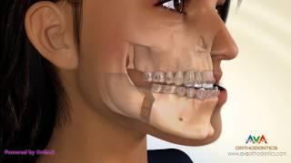 Surgical Orthodontic Treatment for Underbite or Crossbite - BSSO Mandibular Setback