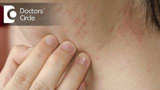 How to identify scabies rash & its management?  - Dr. Sudheendra Udbalker