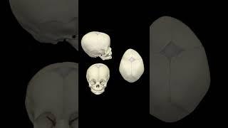 Congenital skull abnormalities (craniosynostosis) #skull #skulldeformity #flathead @fauquierent