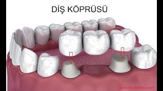 Dental Bridge Procedure