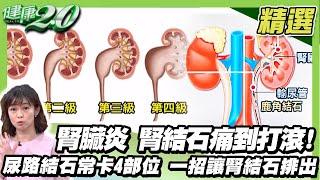 腎臟炎 腎結石痛到打滾！ 水喝不夠.憋尿 恐引爆腎結石.腎臟炎 尿路結石常卡在4部位 這一招讓腎結石自動排出！ 【健康2.0精選】