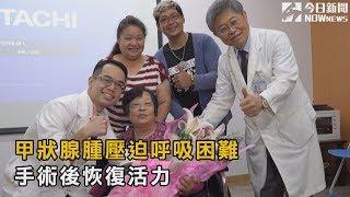 甲狀腺腫壓迫呼吸困難　手術後恢復活力