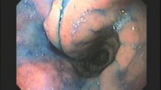 Gastric ectopic mucosa