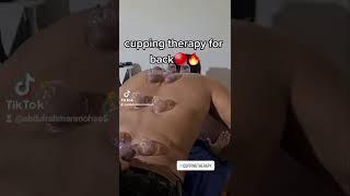 cupping therapy for back