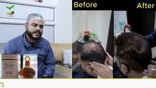 Yachu Hair Oil For Hairloss, Dandruff, baldness | Best Hair Oil |  984-1280071 |