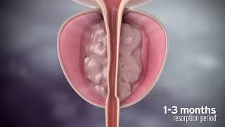 Rezūm Water Vapor Therapy Procedure Animation for Physicians