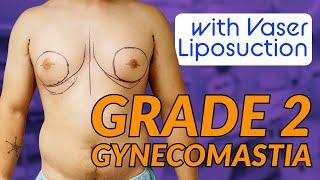 Grade 2 Gynecomastia Surgery with Dr. Dadvand