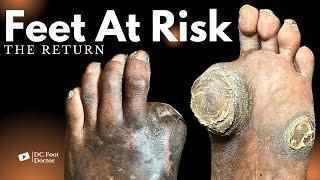 Feet At Risk: The Return