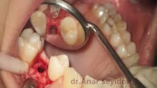 C1 implant placement 3.75x11.5