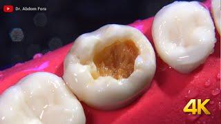 Beautifully Done Dental Restoration