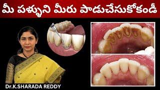 TEETH CLEANING | SCALING | GUM DISEASE| DR.SHARADA in telugu |#teeth #teethcleaning #scaling #health