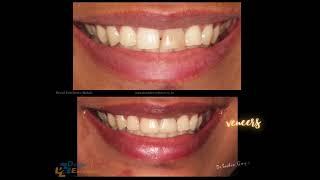 Dental Veneers