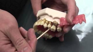 What is Periodontal Disease