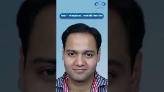 Here is Another Amazing Hair Transplant Result by Dr. A’s Clinic | #shorts #shortsfeed