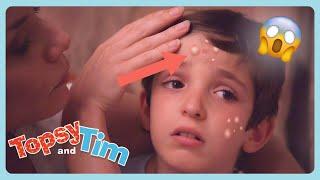 CHICKEN POX!  | Topsy & Tim Full Episode Compilation For Kids | WildBrain Zigzag