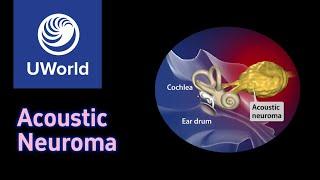 Vestibular Schwannoma/Acoustic Neuroma + Cranial Nerve Anatomy, USMLE UWorld Question, USMLE Step 1