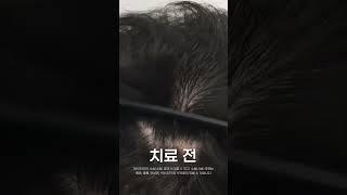 #탈모 치료하는 이유  (무보정)