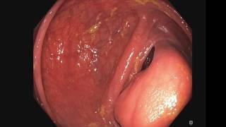 Endoscopic resection of large colonic lipomas