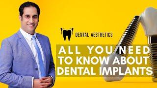 All you need to know about Dental Implants  |  Dr. Shahzad Mirza - Dental Aesthetics