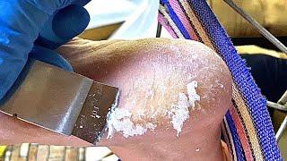 Feet callus removal& old skin cleaning【TD foot care】#stress   3