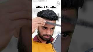 Seven Months Hair Transplant Results | Latest Fue Technique #shorts #viral #hair transplant