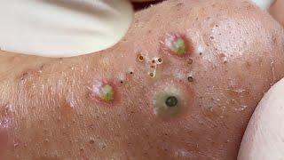 Big Cystic Acne Blackheads Extraction Blackheads & Milia, Whiteheads Removal Pimple Popping # 1276