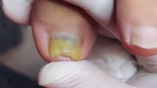 Cut Big Dirty Ingrown Toenail 521 剪大脏向内生长脚趾甲 #health #shorts