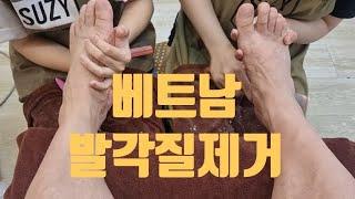 베트남 다낭 발각질제거 해주셔서 감사합니다