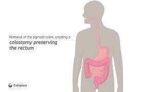 Creation of end colostomy by removing sigmoid colon | Ostomy surgery | Coloplast India