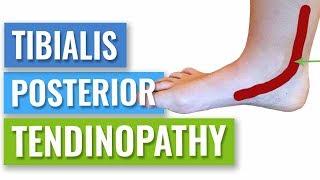 How to Get Rid of Posterior Tibial Tendonitis