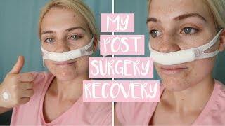 WHAT TO EXPECT AFTER NASAL SURGERY | First Week of Post-Sinus (Septoplasty) Operation Recovery!