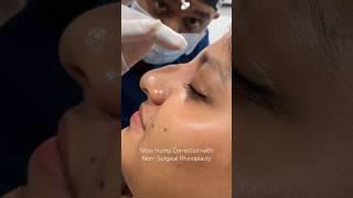 "Nose Hump Fix in Minutes: Non-Surgical Rhinoplasty at Cara Clinic Mumbai!"