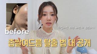 (SUB) ‘피부 뒤집어진 나의 과거…좁쌀여드름 극복 법 대 공개!’ | 좁쌀 여드름 없애는 비밀 습관 | 트러블 안녕 꿀템들!