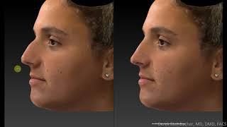 Rhinoplasty. 3D analysis simulation & actual. Modern cosmetic nose job results