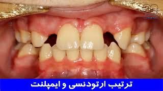 ترتیب ارتودنسی و ایمپلنت | دکتر احسان مهریزی