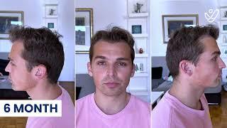 9 Month DHI Hair Transplant Results | 2700 Grafts Before and After