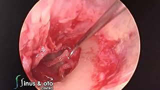 Endoscopic Tympanoplasty