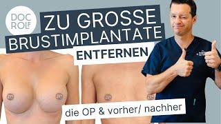 Zu große BRUSTIMPLANTATE entfernen - inklusive vorher/nachher – doc.rolf