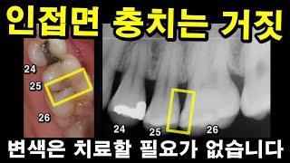 인접면 충치는 거짓. 변색은 치료할 필요없음. 속아서 인레이, 크라운 당하지 마셈.옆면충치 엑스레이에 빈공간이 있으면서 탐침으로 긁혀나올때만 치료. 2022.05.26