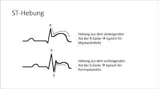 EKG verstehen; die Grundlagen (EKG Crashkurs Teil 1)