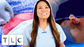 The Top 3 Most Watched Pimple Popping Moments! | Dr. Pimple Popper