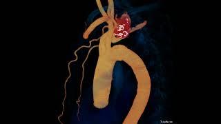 subclavian pseudoaneurysm