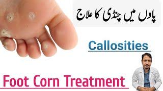 Foot Corn Treatment Urdu Hindi| Corn ke ilaj in urdu | Chandi Ka Ilaj | Irfan Azeem |