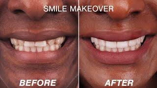 Before & After Smile Make-over Transformations 2022 | Cosmetic Dentistry Dental Boutique