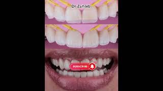 Composite resin restoration by Dr Zuhaib Hussain #dentist #shorts